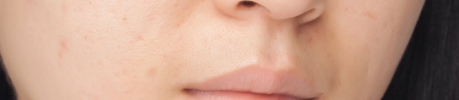 A targeted skincare routine can help remove pimple marks