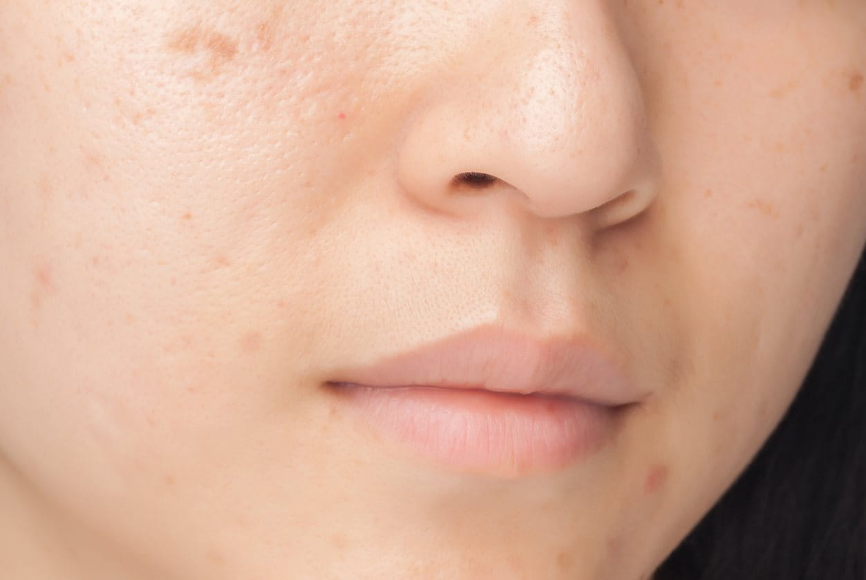 acne scarring on the skin