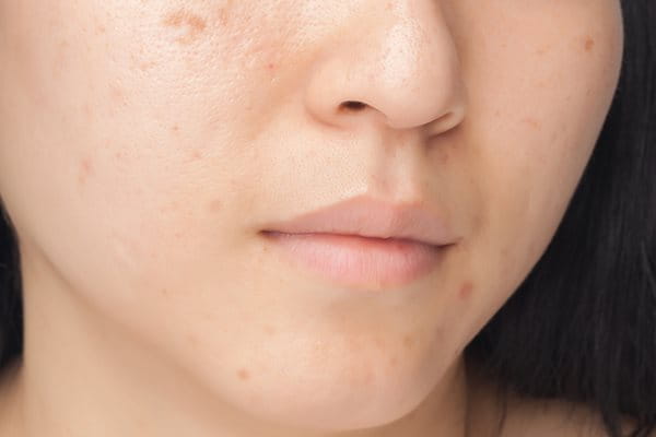 Marques acné - Effets sur la peau | EUCERIN