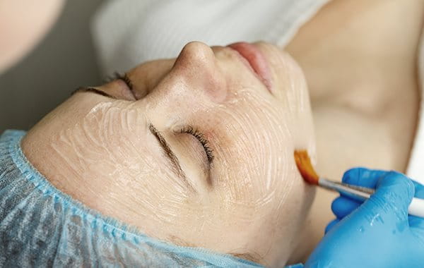 chemical peels for pimple marks