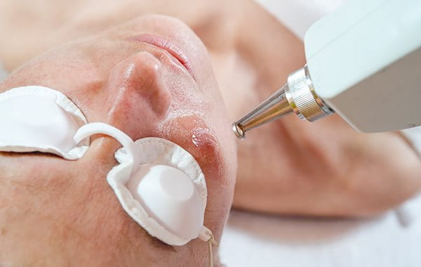 laser therapy for pimple marks