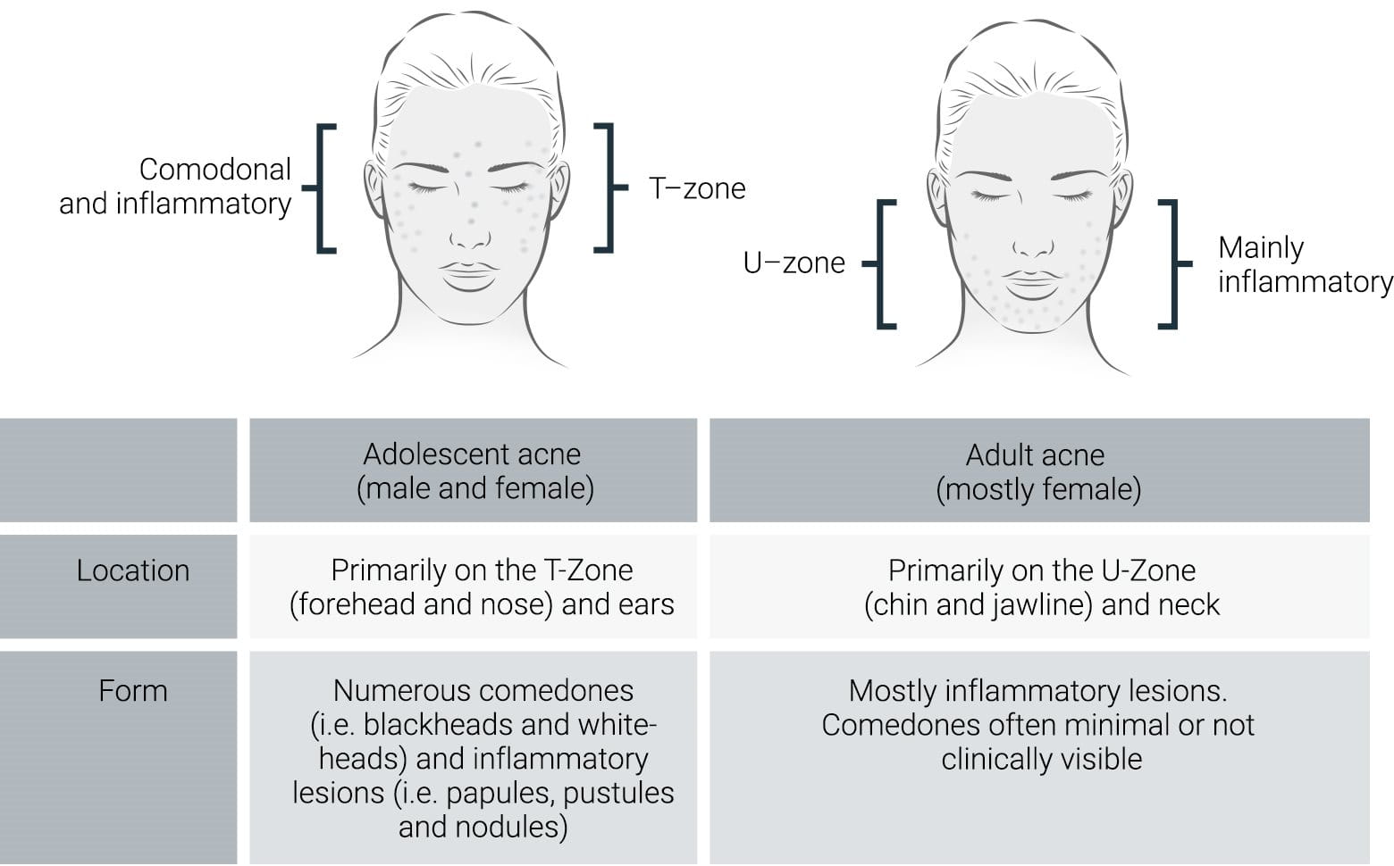 adult acne vs teenage acne