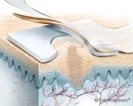 Medicinsk illustration af et ligtorneplaster