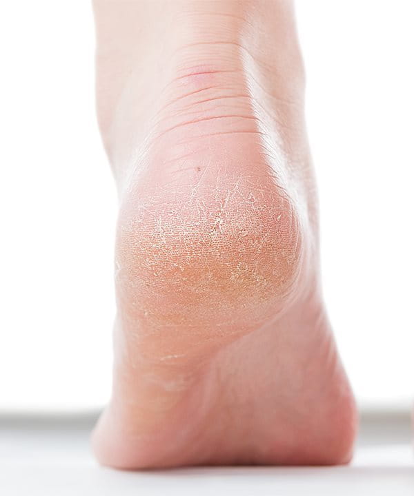 Dry skin on 2025 one foot