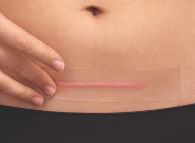All You Need to Know About Your C-Section Scar