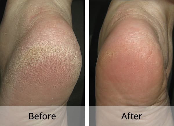 Hardening Of Skin On Foot on Sale | emergencydentistry.com