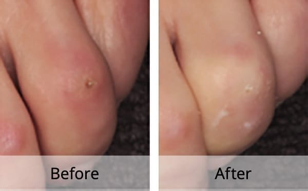 Remove hard skin on on sale feet