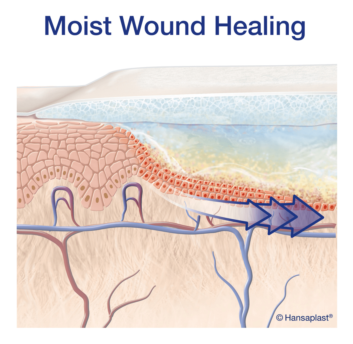 Image of moist wound healing