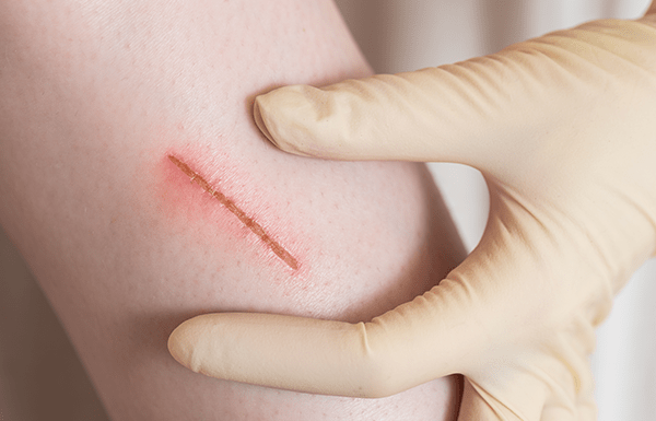 Heridas cerradas