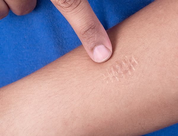 Finger zeigt auf Narbe am Arm