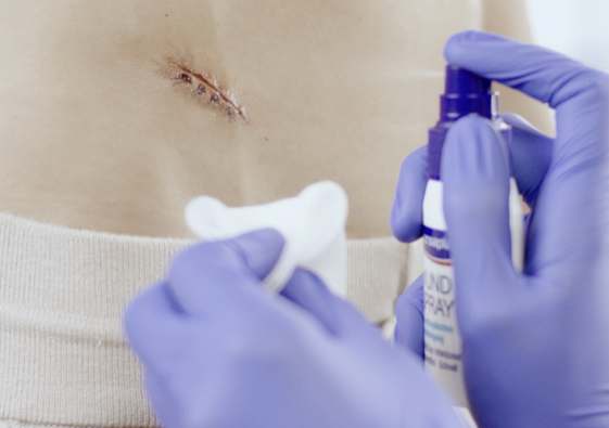 Hansaplast wondspray op een wond na operatie