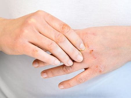 Fissures au bout des doigts: comment les guérir – Hansaplast