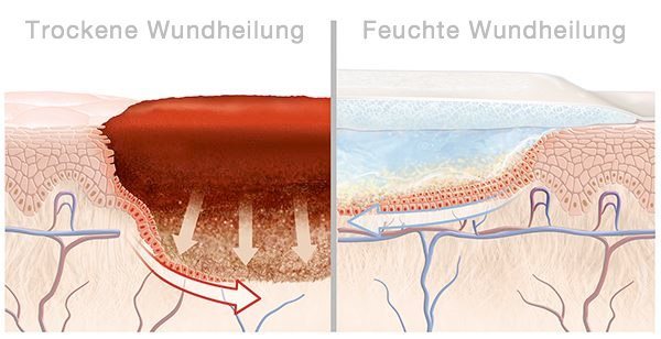 Schnelle Wundheilung mit geringem Narbenrisiko | Hansaplast