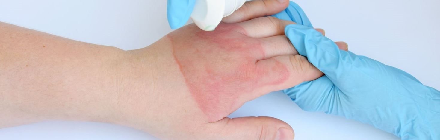 Verbrennung zweiten Grades an der Hand behandeln