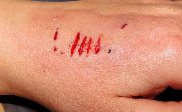 cuts on hand