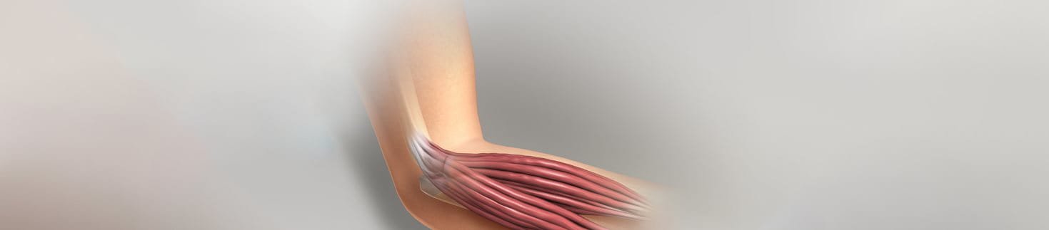 epikondylitida-agkwna