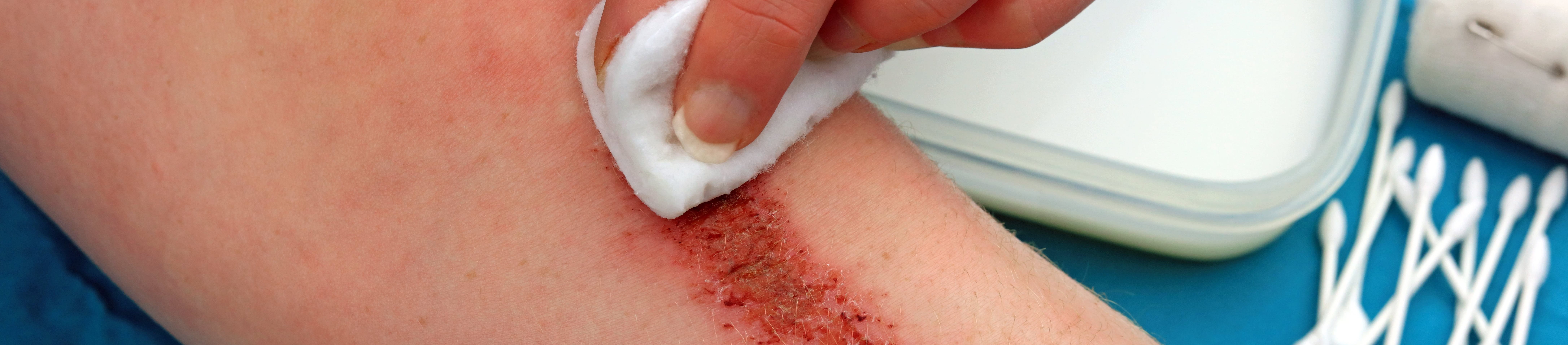 Cara yang perlu dilakukan untuk mencegah infeksi luka.