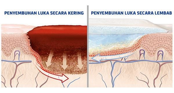 Dengan mejaga luka tetap lembab, berikut beberapa manfaat yang dapat dirasakan: