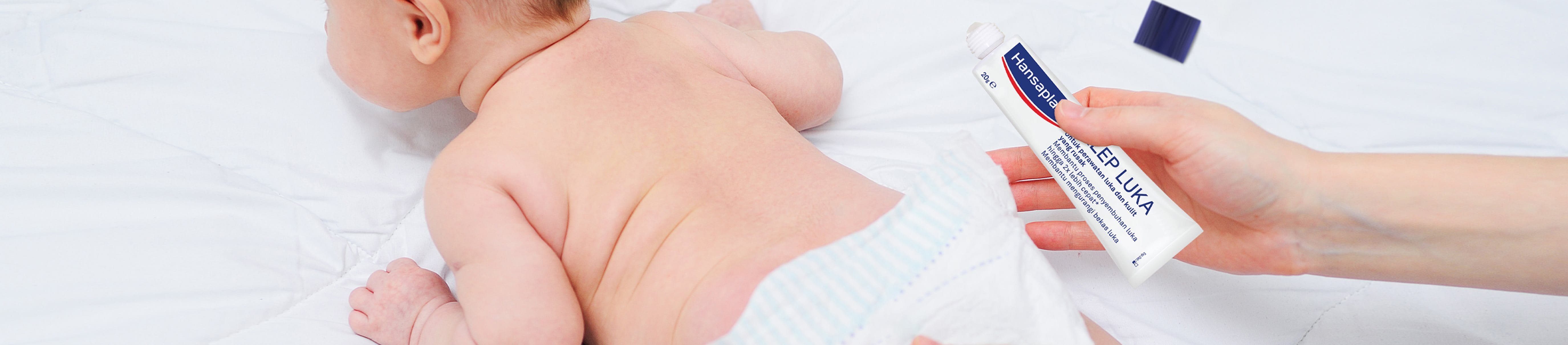 Ruam popok dapat diatasi dengan Hansaplast Salep Luka