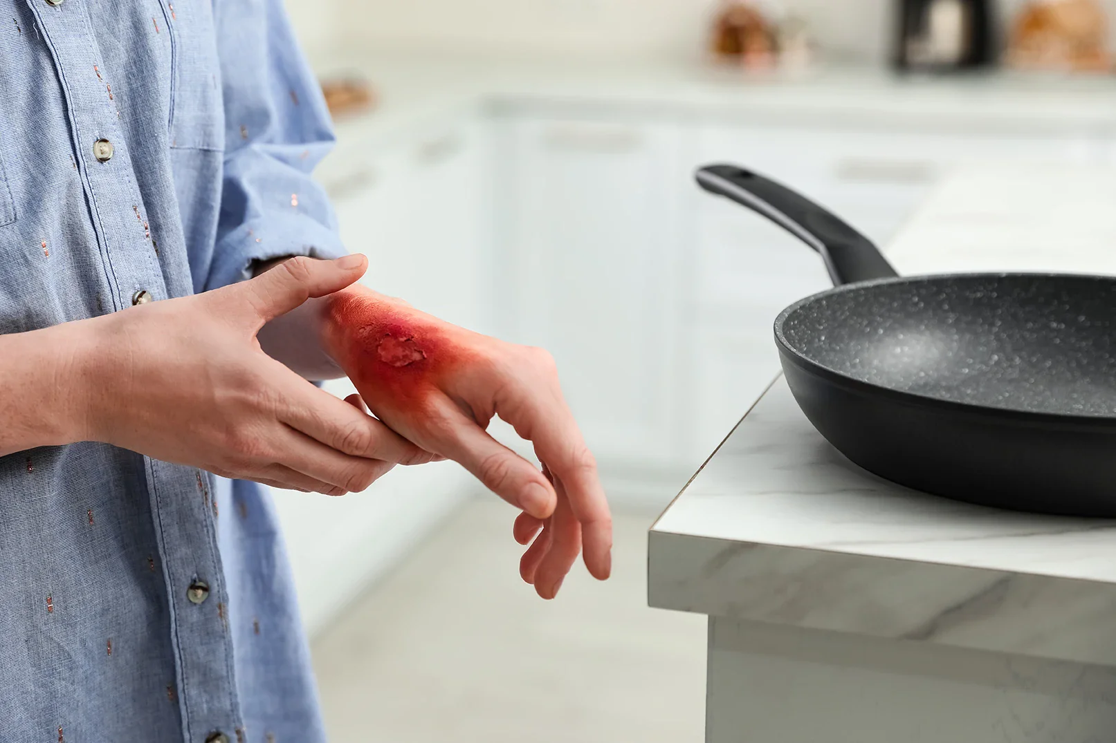 Jenis luka bakar yang terjadi di dapur.