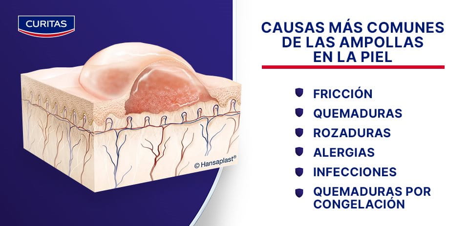 Ampolla en las camadas de la piel