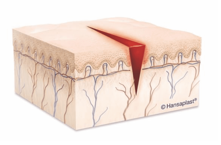 Anatomie van een wond