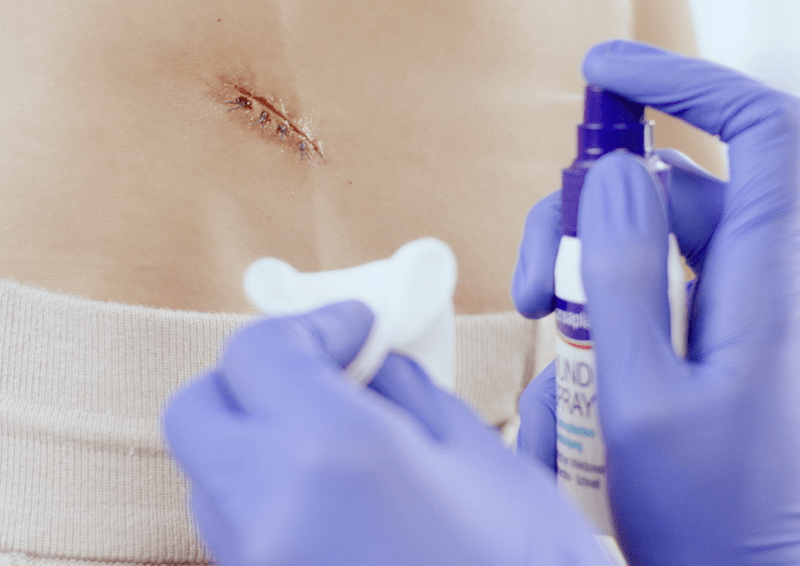 Ontstoken wond verzorgen met wondspray