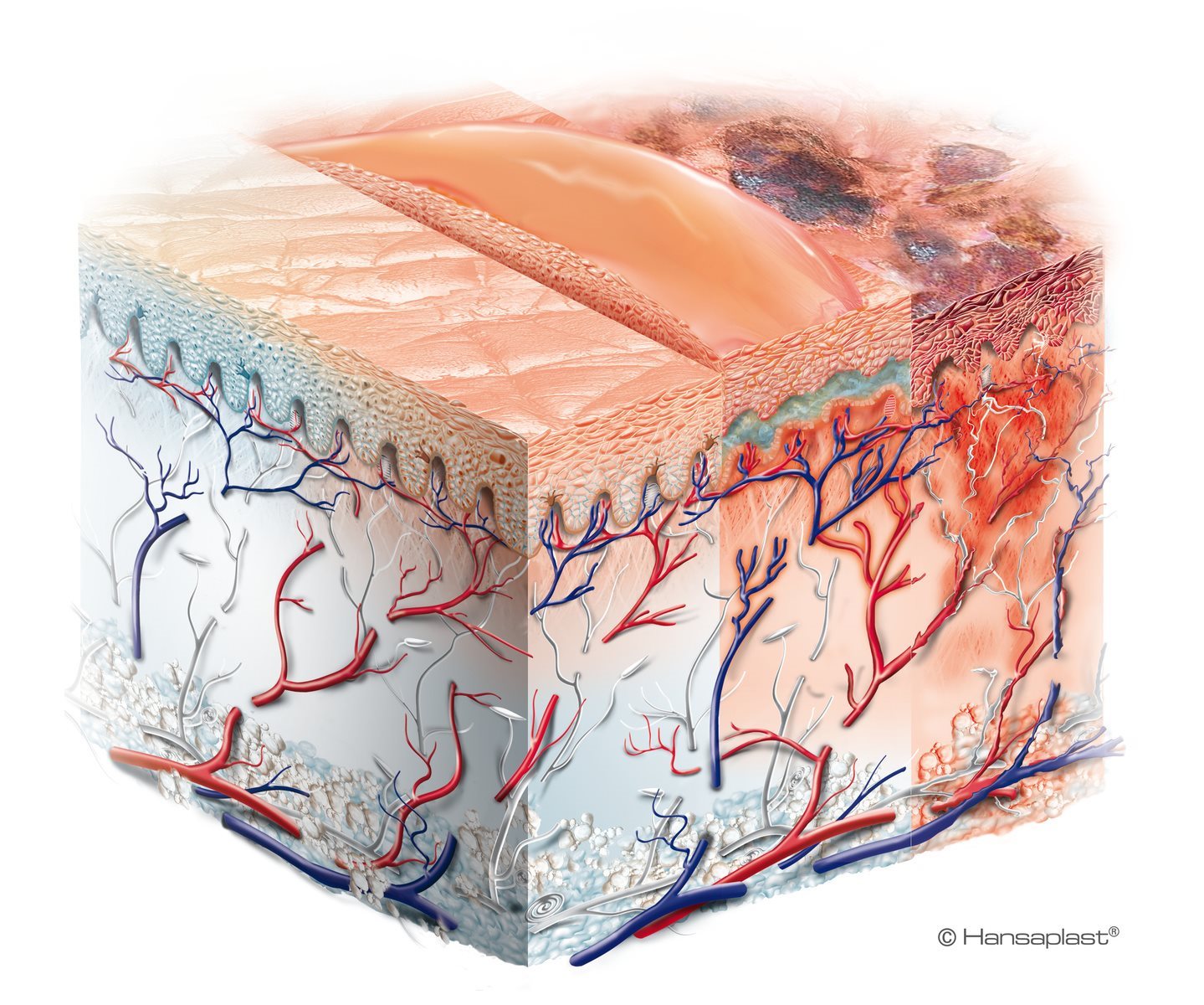 image médicale d'une brûlure du troisième degré