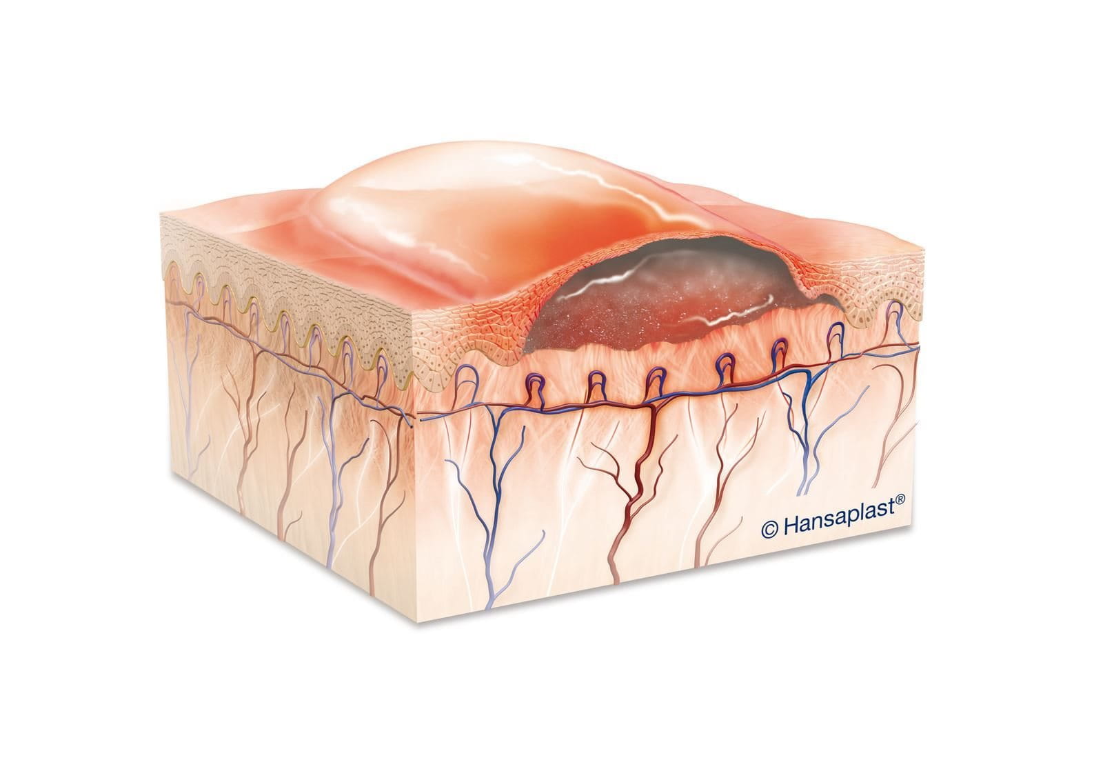 image médicale d'une brûlure du deuxième degré