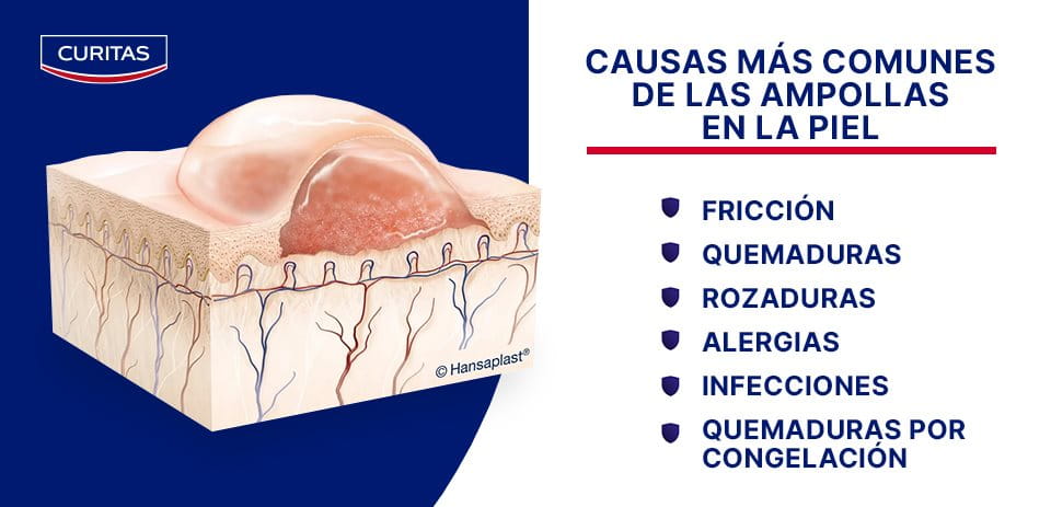 Causas de las ampollas en la piel