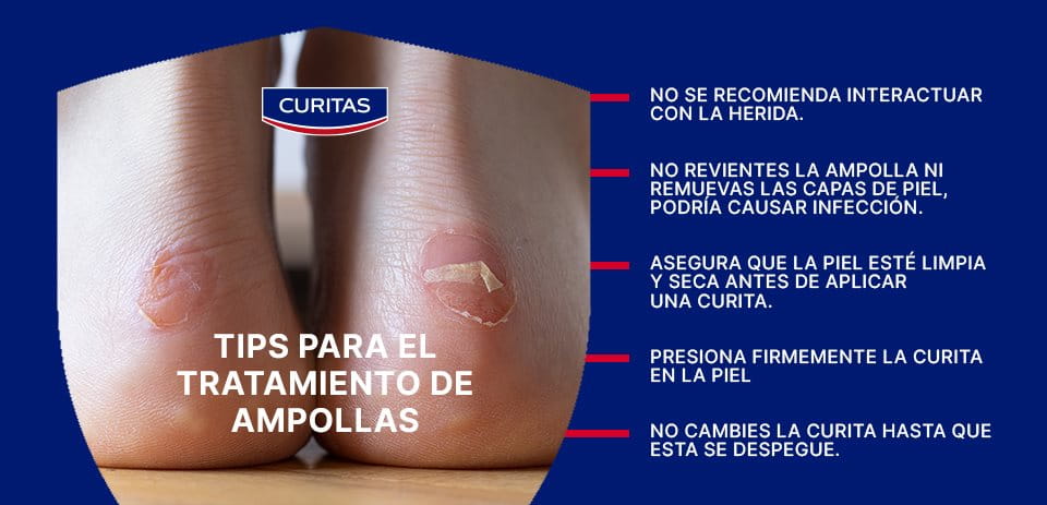 Tips para tratamineto de las ampollas en la piel