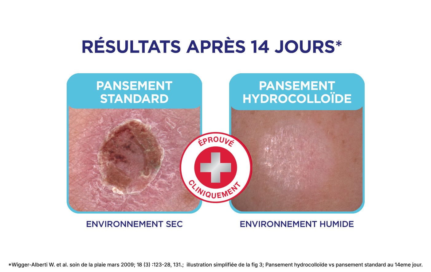 Images avant et après comparant les résultats après 14 jours de soins des plaies avec un pansement standard par rapport à un pansement hydrocolloïde dans un environnement sec et un environnement humide.