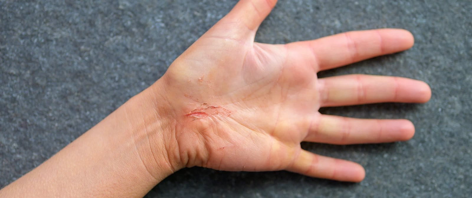  Luka gores dapat terjadi di mana saja, termasuk di rumah