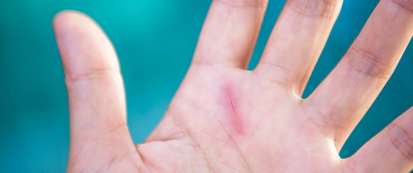 Luka yang cepat ditangani akan sembuh dengan lebih baik