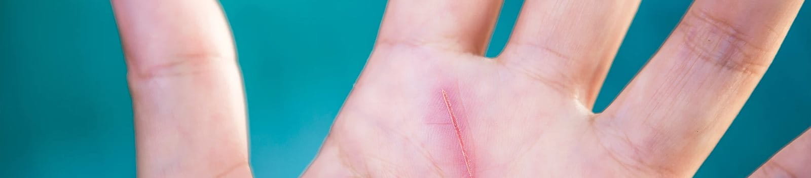 Luka yang cepat ditangani akan sembuh dengan lebih baik