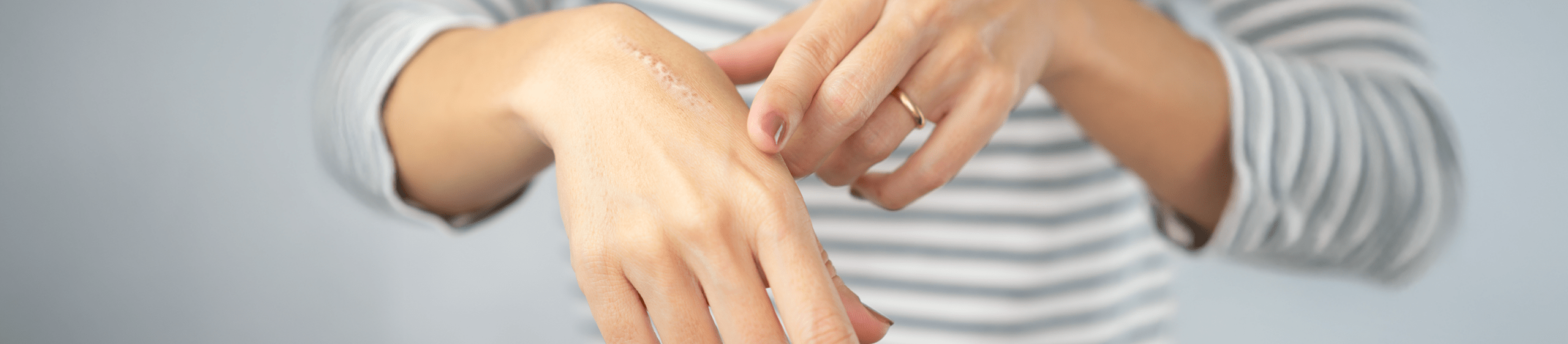 Tratamiento para cicatrices