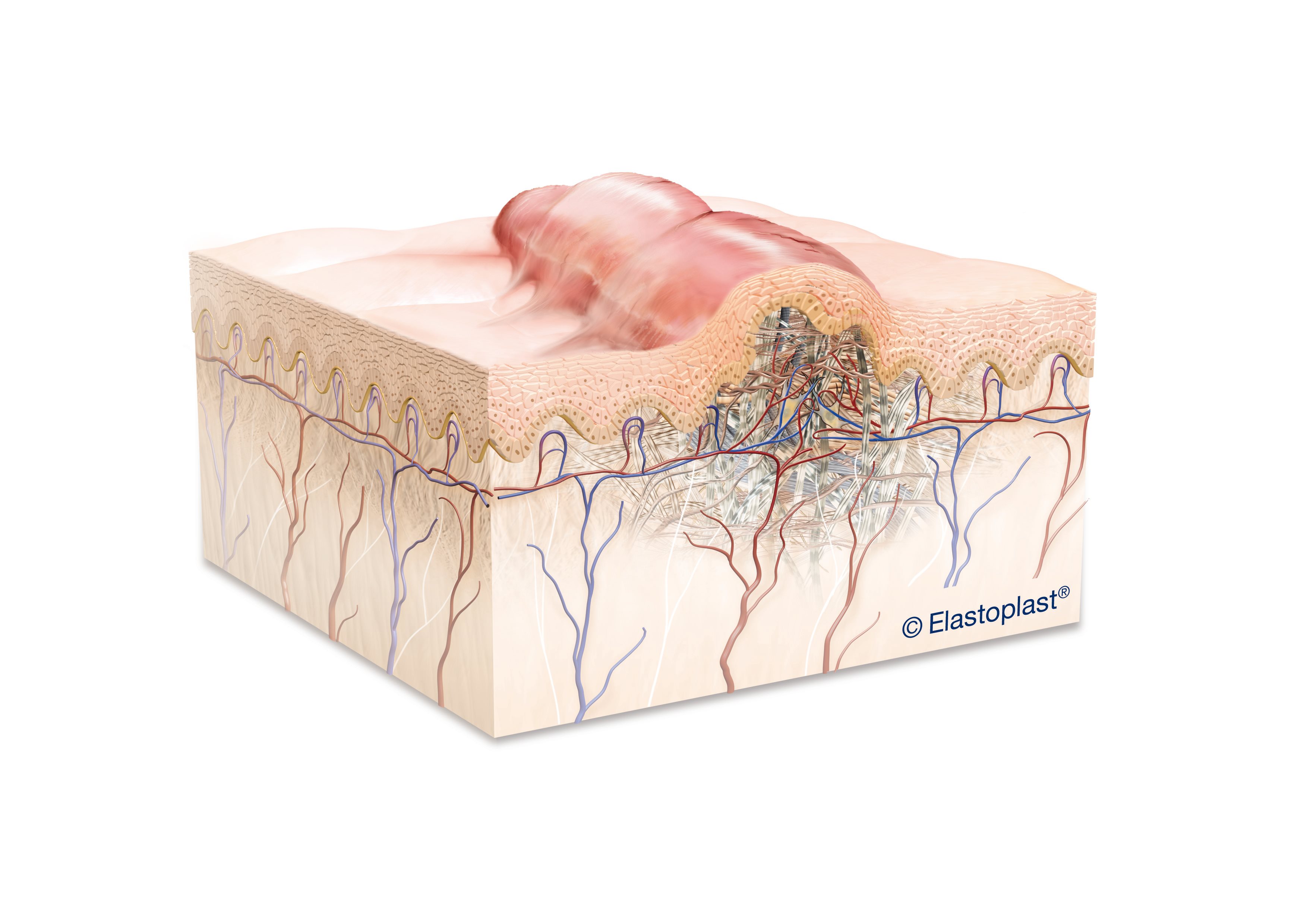 biological diagram of a keloid scar