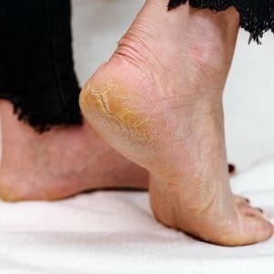 piel seca y callos en los pies