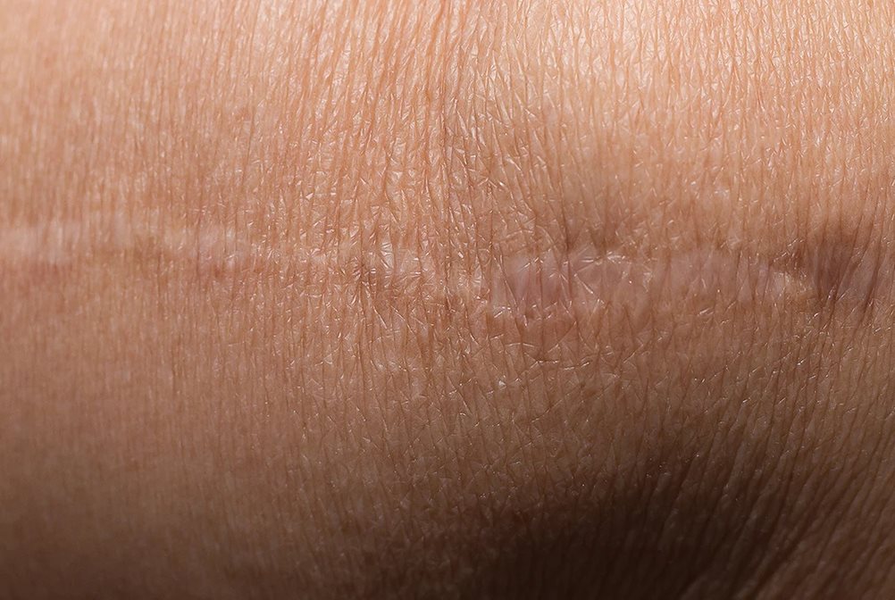 bekas luka di tangan