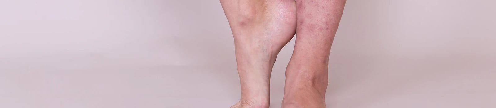 Bekas koreng di kaki sangat mengganggu aktivitas Anda