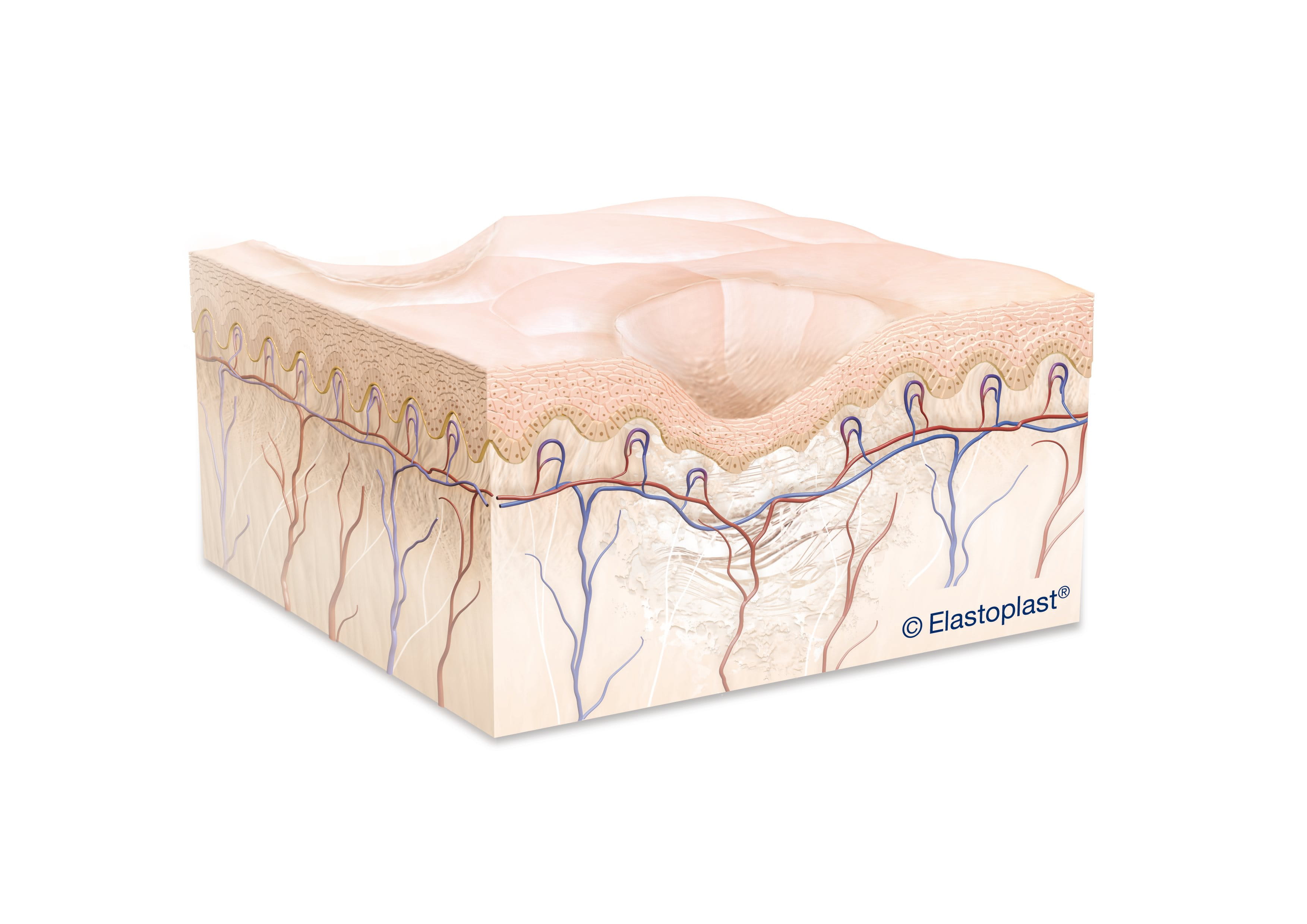 Image showing atrophic scars with small skin depressions commonly caused by acne or chickenpox. 