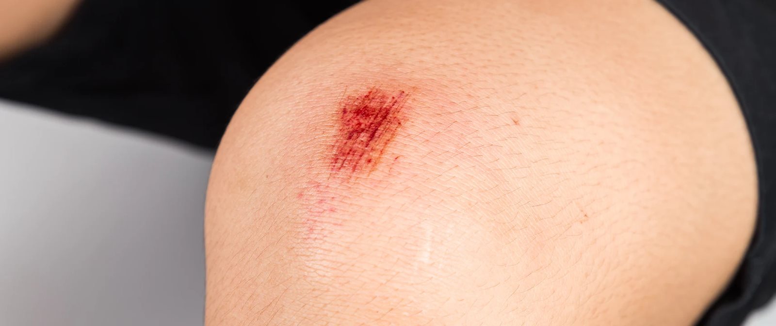 Pertolongan pertama pada luka gores yang perlu diketahui.