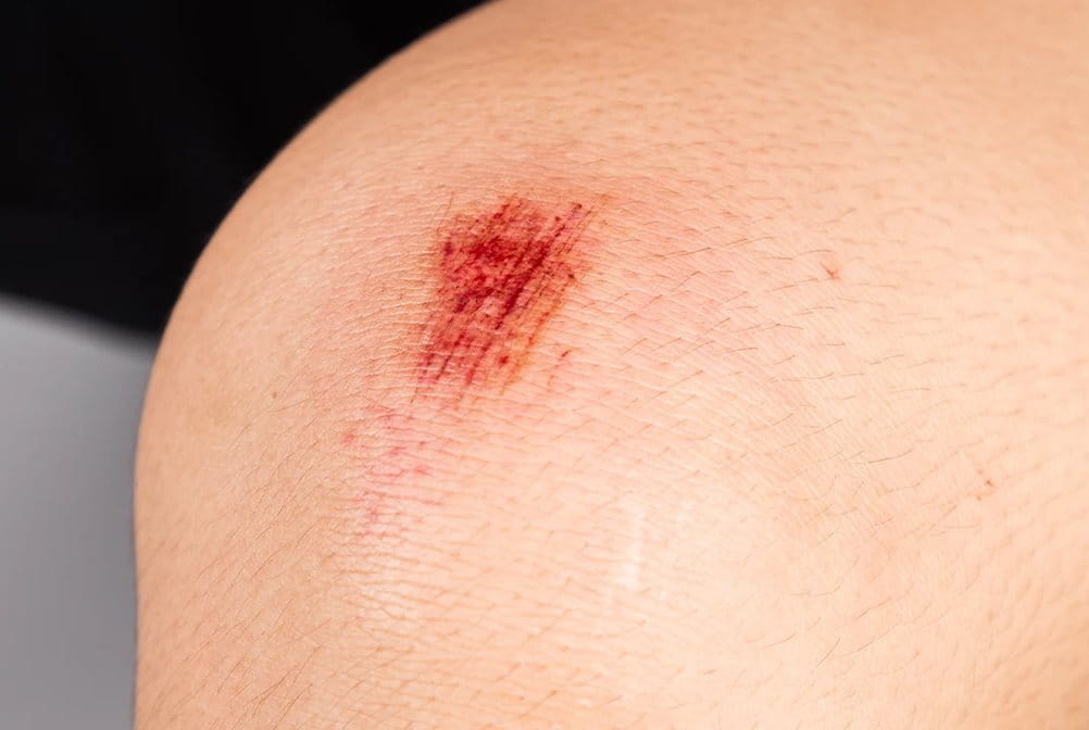 Pertolongan pertama pada luka gores yang perlu diketahui.