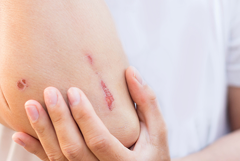 Aufgeschürfter Ellenbogen