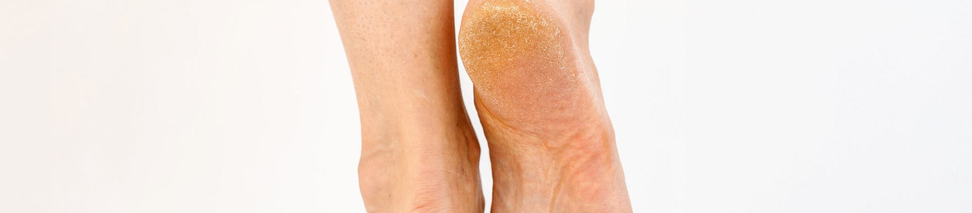 Problemas comunes de los pies