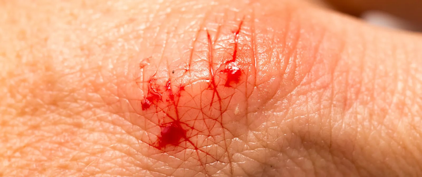 Cara mengatasi luka infeksi dengan baik