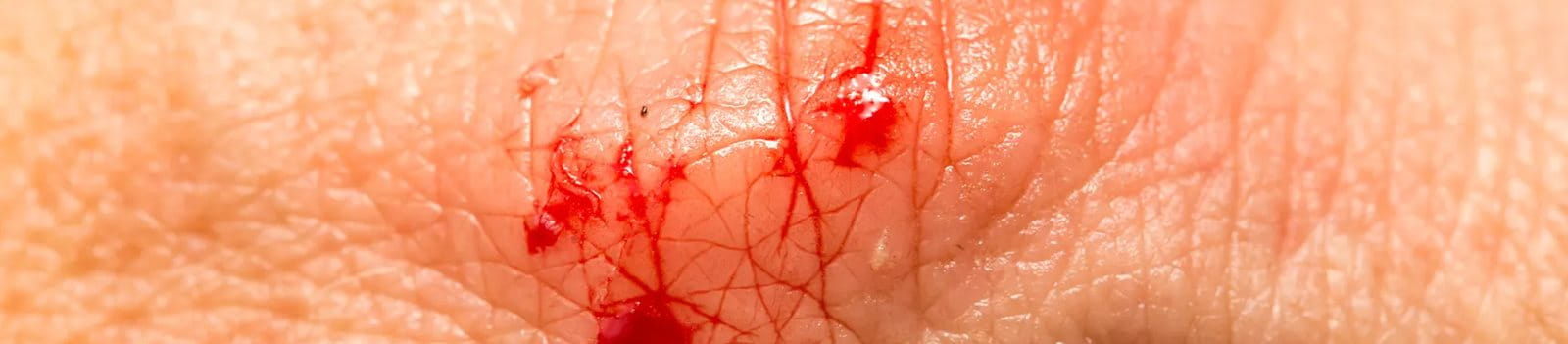 Cara mengatasi luka infeksi dengan baik