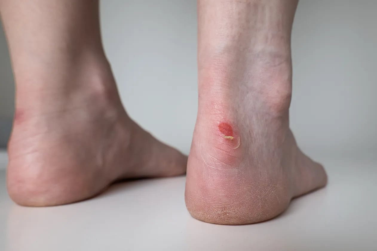 Kaki lecet karena pemakaian sepatu