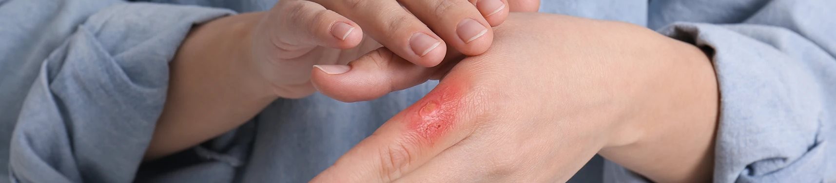 Tangan terkena air panas menimbulkan rasa nyeri