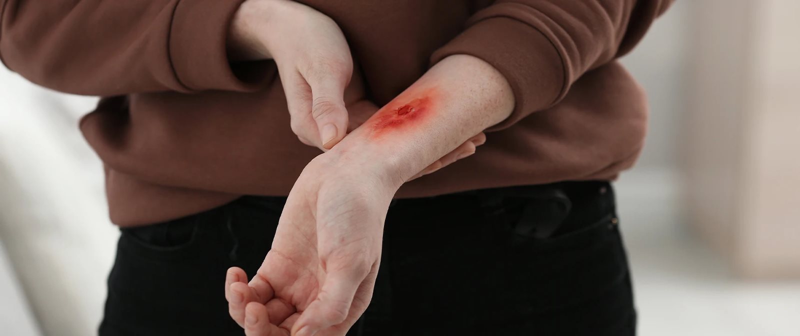 Langkah penanganan luka bakar yang tepat.